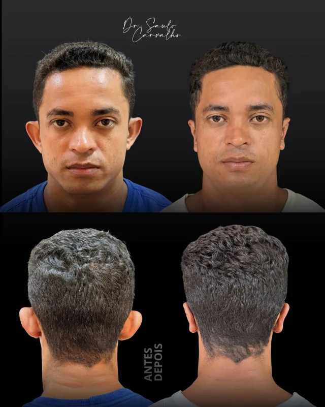 Antes e depois: Otoplastia