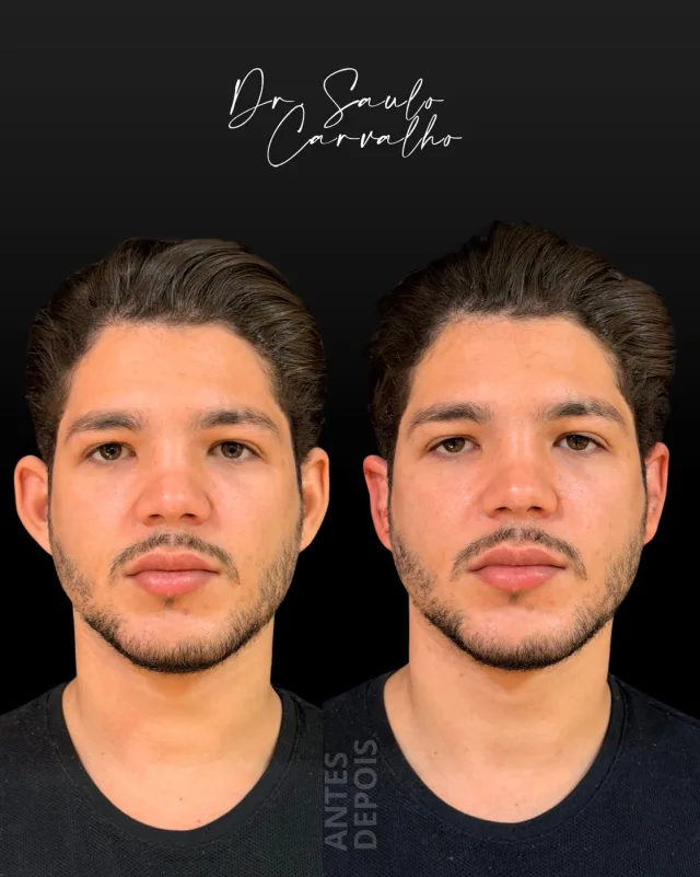 Antes e depois: Otoplastia