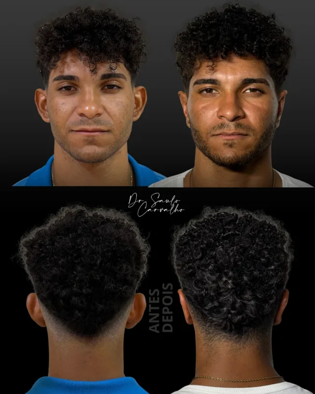 Antes e depois: Otoplastia